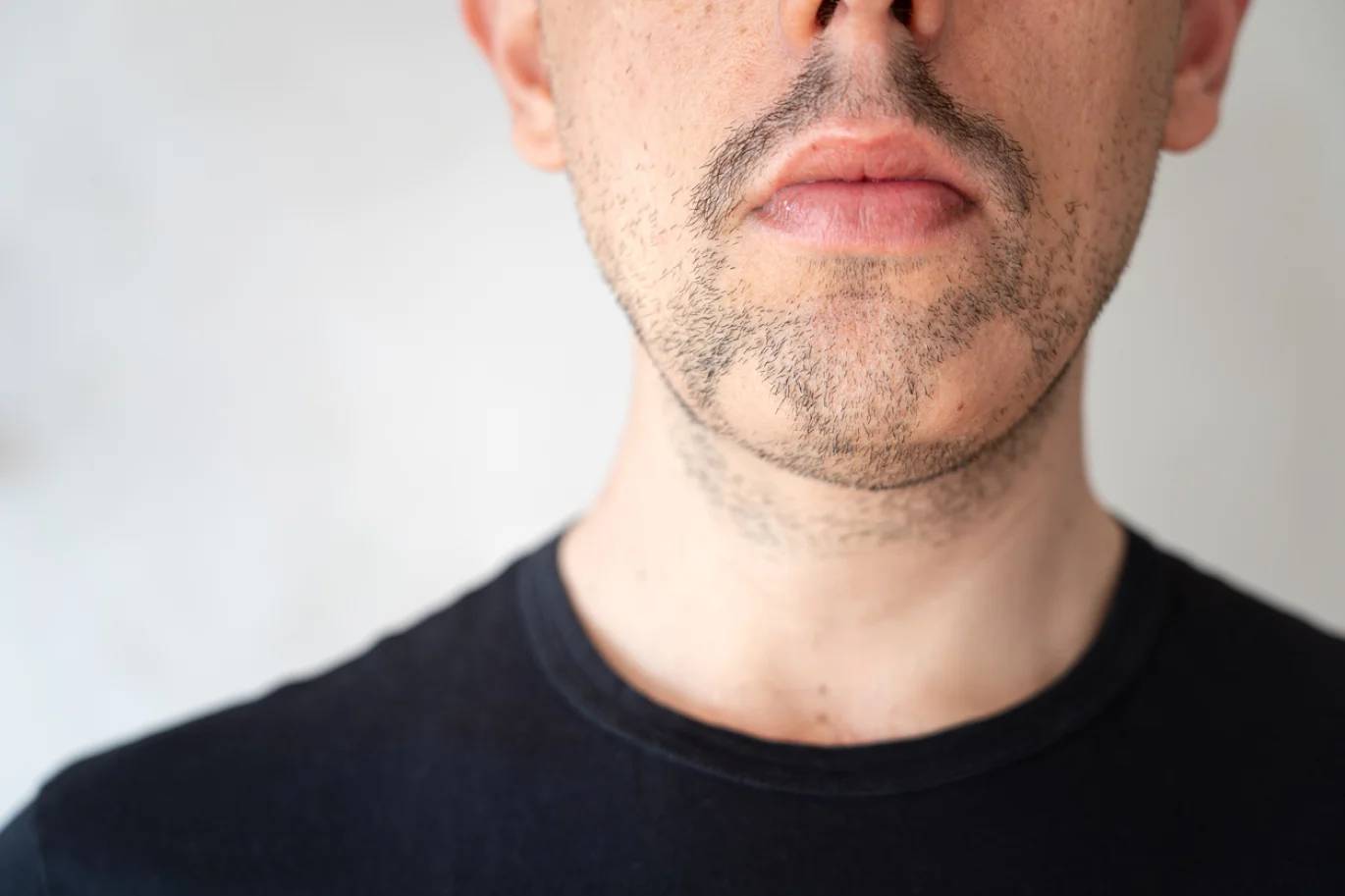 Why beard hair loss happens and how to treat it - Reader's Digest