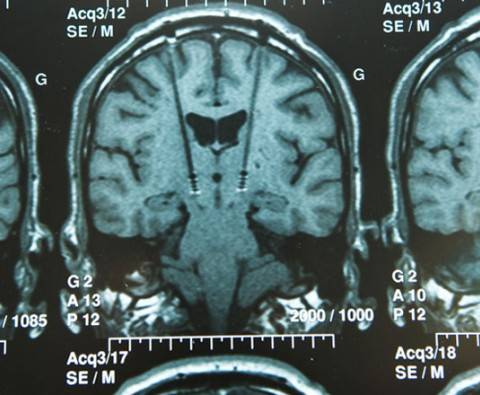 How Deep Brain Stimulation can help Parkinson’s