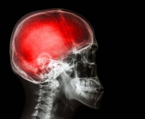 What happens during a stroke?