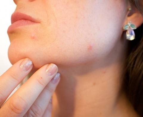 What’s causing your acne?
