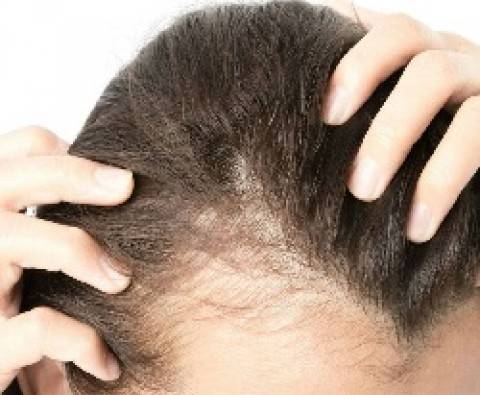 Female hair transplants - all you need to know
