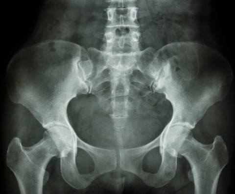 How to avoid a hip fracture