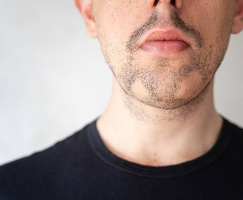 Why beard hair loss happens and how to treat it
