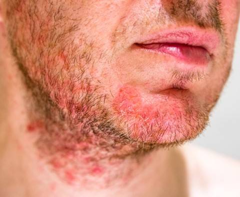 What is Folliculitis and how does it cause hair loss?