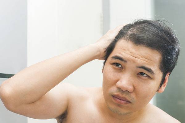 How to cope with male pattern baldness - Reader's Digest